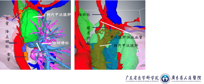 赛纳数字医疗手术三维重建